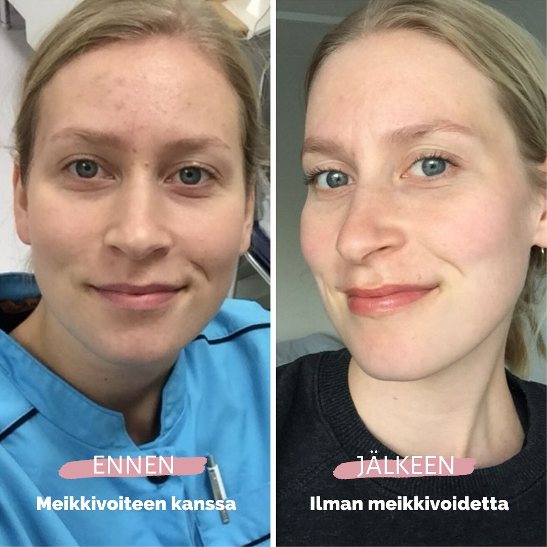 Eroon pinatkuivuudesta ja finneistä